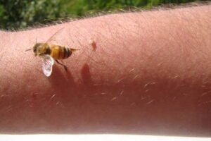 bee : apis mellifera.
treatment by honey bee sting.
closeup honey bee stinging a hand.
close up bee worker.
insects, insect, animal, wildlife, wild nature, forest, woods, garden
beauty of pollination
