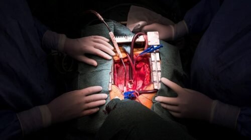 MTI101. BUDAPEST (HUNGRÍA), 03/03/2018.- Cirujanos observan el pecho de un paciente tras extraerle el corazón durante un trasplante de corazón en el Centro Varosmajor de la Universidad de Semmelweis en Budapest (Hungría) el 3 de marzo de 2018. El primer trasplante de corazón realizado en Hungría con éxito se realizó en el centro Varosmajor hace 26 años, el 3 de enero de 1992, por el profesor Zoltan Szabo y su equipo. Más de 560 trasplantes de este tipo se han realizado desde entonces, pero no fue hasta el 8 de octubre de 2008 que se realizó con éxito en un niño. EFE/ Marton Monus